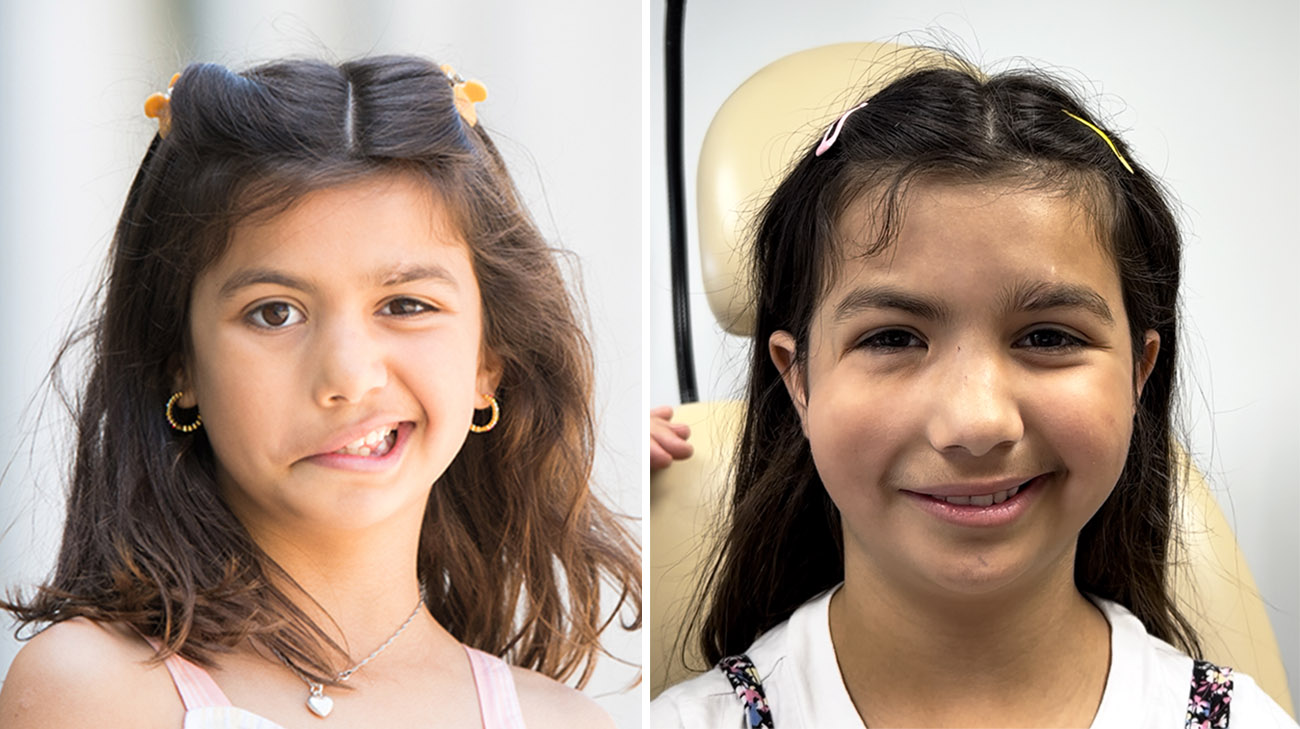 Nicole before and after facial reanimation surgery.