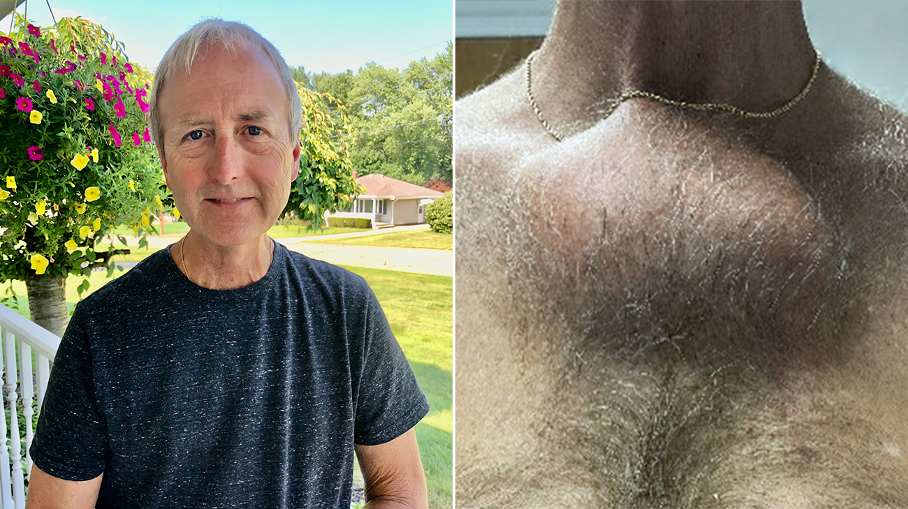 Portrait of Edward on left, and a chondrosarcoma on Edward's chest on right.